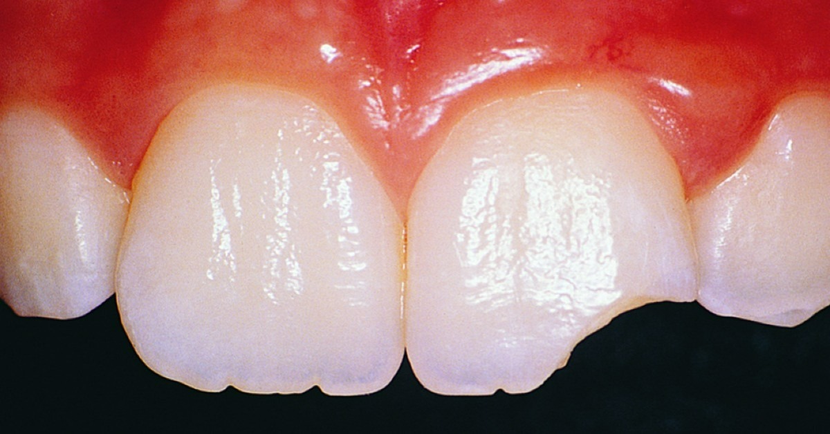 Quelles sont les causes d'une dent ébréchée ?